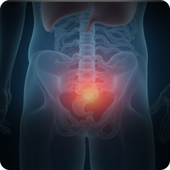 Cáncer de vejiga Miami