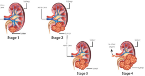 Tratamiento del cáncer de riñón en Illinois