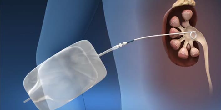 Percutaneous Nephrolithotomy Treatment Miami