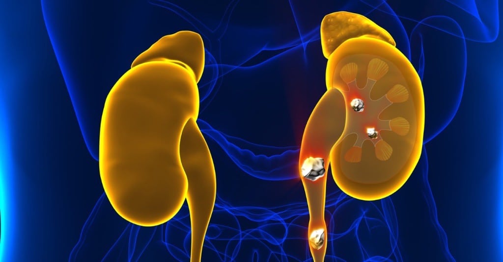 Ureteroscopy For Kidney Stones Miami