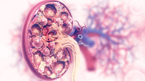 Is Kidney Cancer Curable? What Patients Need to Know