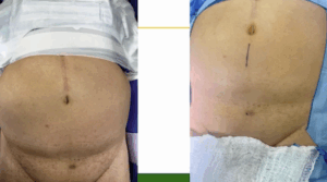 single port extraperitoneal robotic prostatectomy