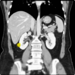 Single Port Partial Nephrectomy