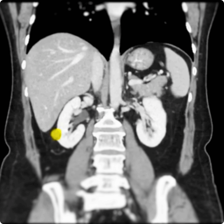 Single Port Partial Nephrectomy