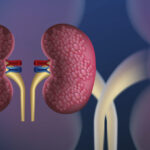 Kidney Carcinoma Explained: Diagnosis, Staging, and Survival Rates