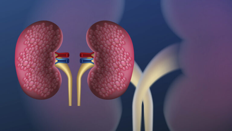 Kidney Carcinoma Explained: Diagnosis, Staging, and Survival Rates