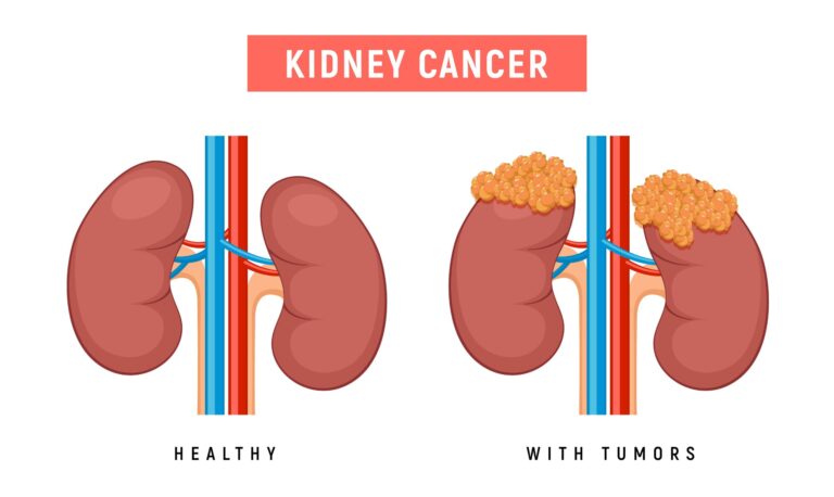 Kidney Cancer Treatment in Wisconsin