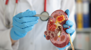 Kidney Cancer Treatment Illinois