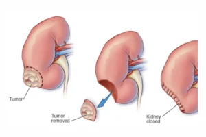Robotic Partial Nephrectomy vs. Traditional Surgery