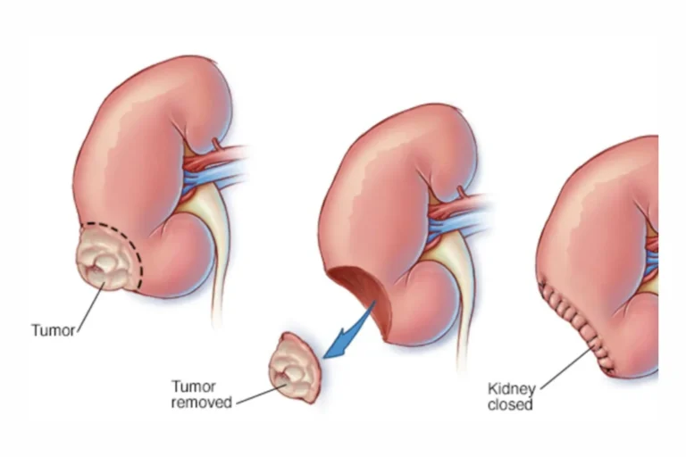 Robotic Partial Nephrectomy vs. Traditional Surgery